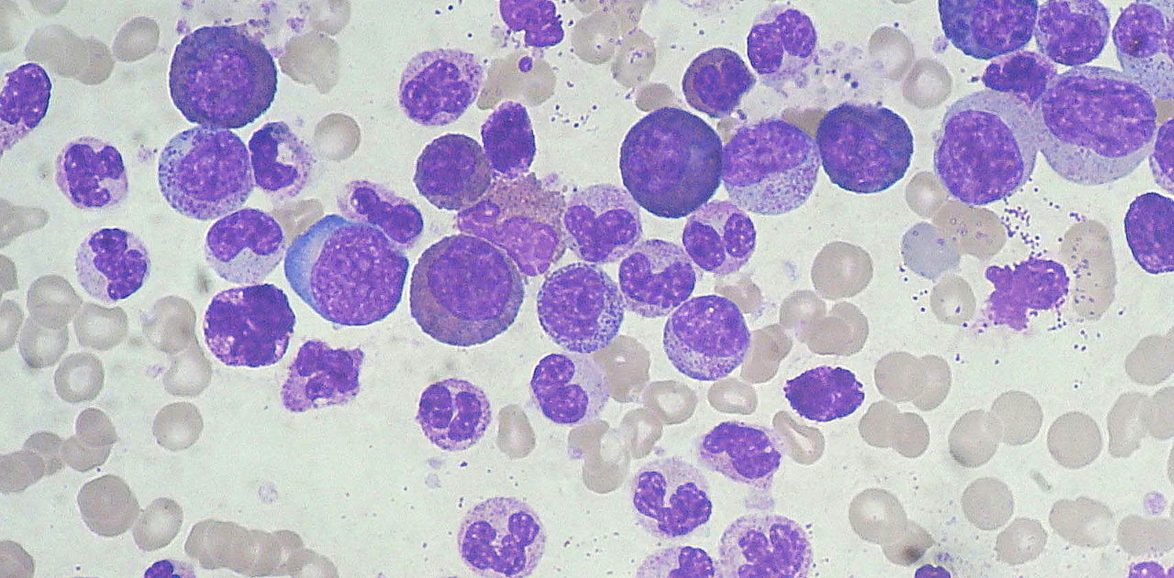 Funcionamiento del genoma e la leucemia