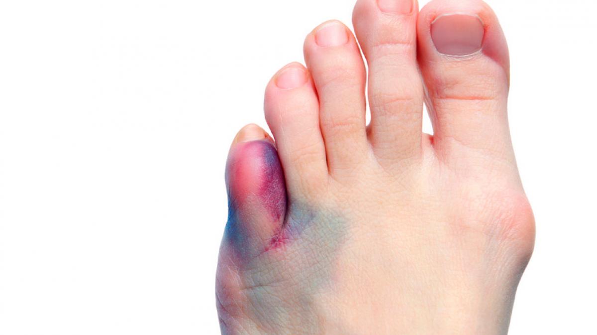 Fractured Little Finger,Fractura Dedo Meñique,Frattura del mignolo