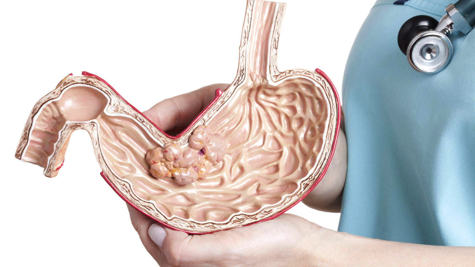 Tratamiento para el Cáncer de Estómago