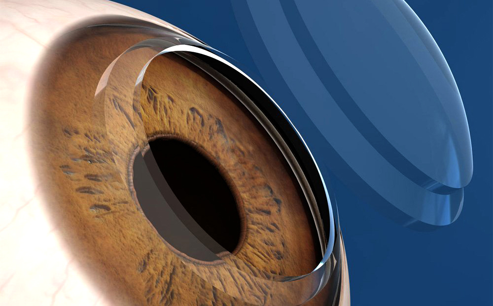 Reparación de córnea