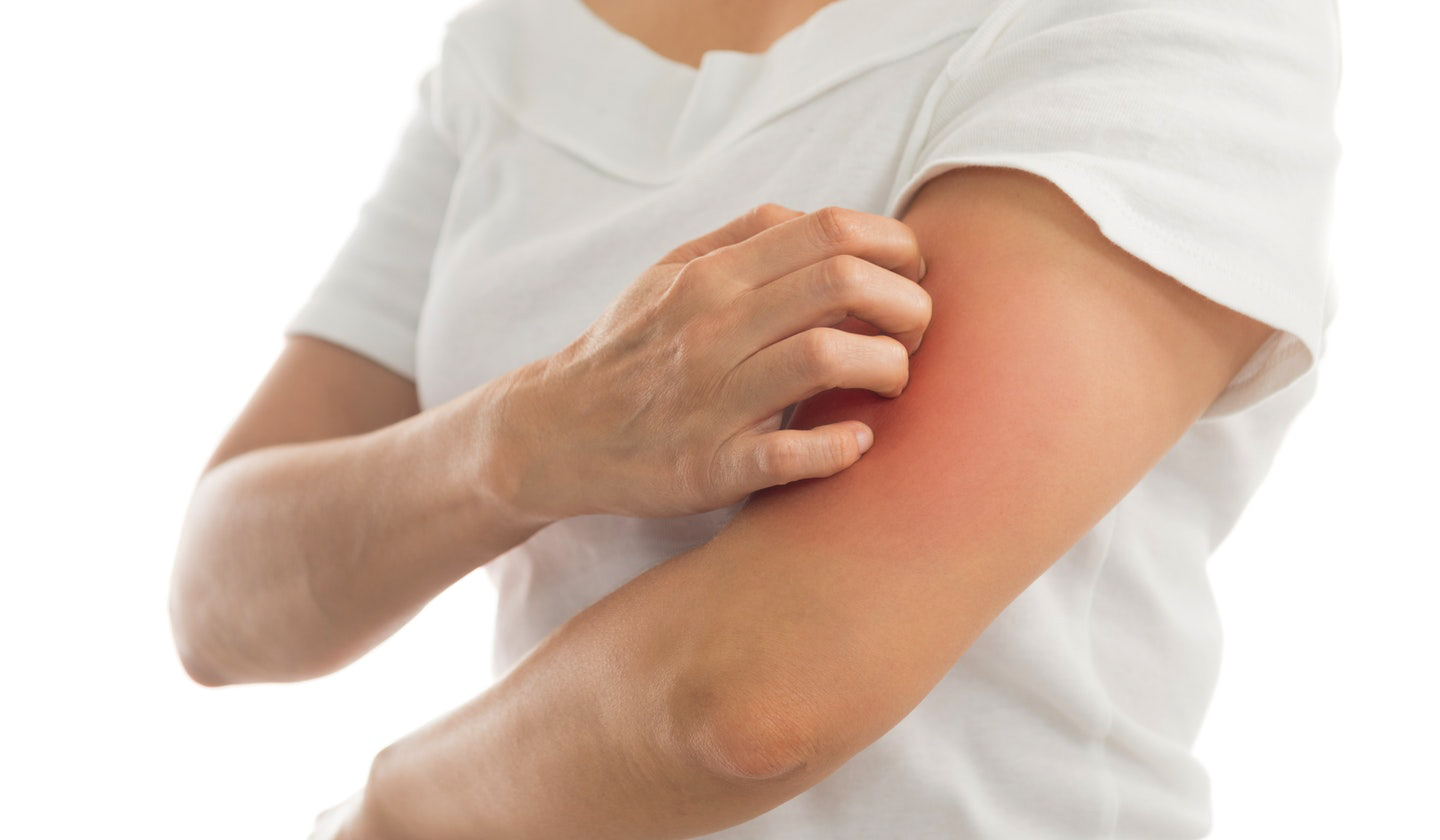 Tratamiento para la sarna