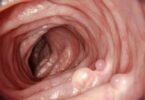 Pólipo uterino, uterine polyps, polipi uterini
