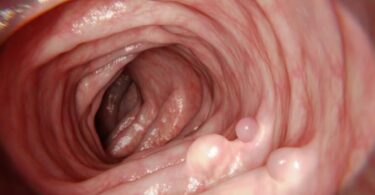 Pólipo uterino, uterine polyps, polipi uterini