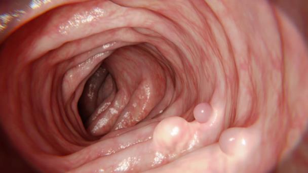 Pólipo uterino, uterine polyps, polipi uterini