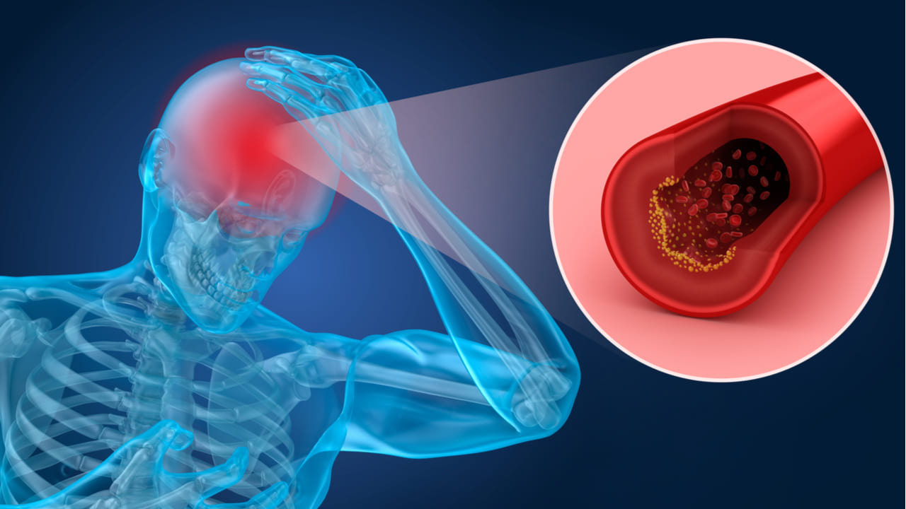 ¿De qué trata la mal formación arteriovenosa y qué consecuencias trae a nuestro organismo?