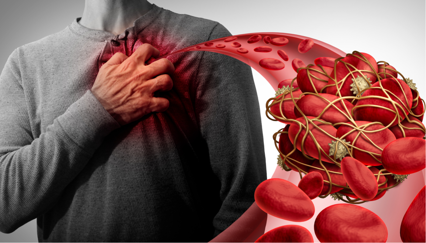 Una de las vacunas contra el Covid-19, produce el trastorno de trombosis llamado síndrome de plaquetopenia.