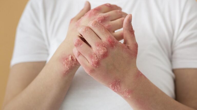 Psoriasi: qui trovate le informazioni necessarie